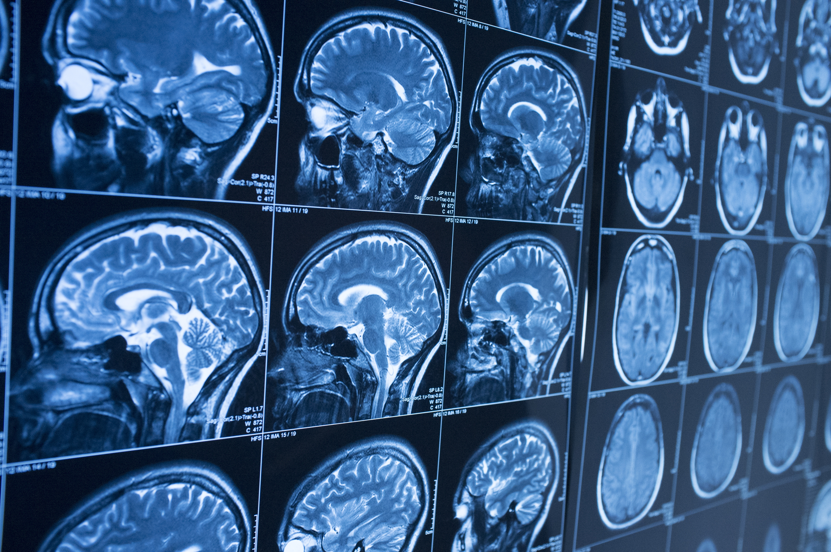 What Is Hemiplegia?